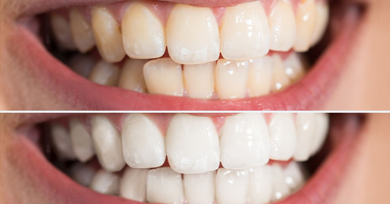 AT-HOME VS. IN-OFFICE TEETH WHITENING