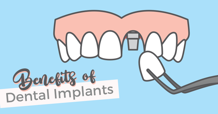 graphic of dental implants