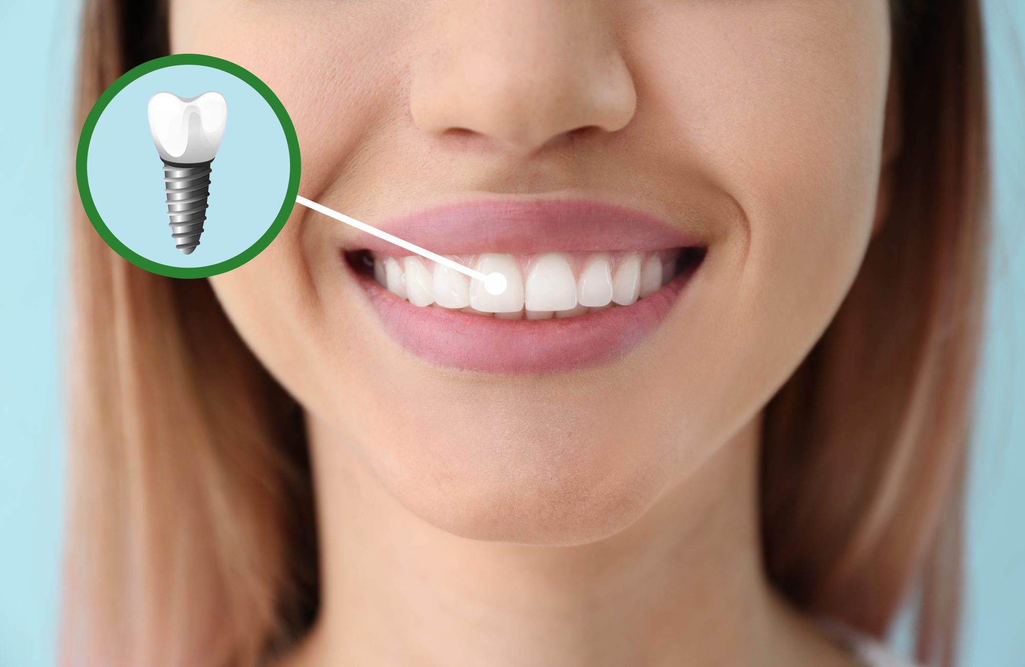 The Top 4 Benefits of Dental Implants