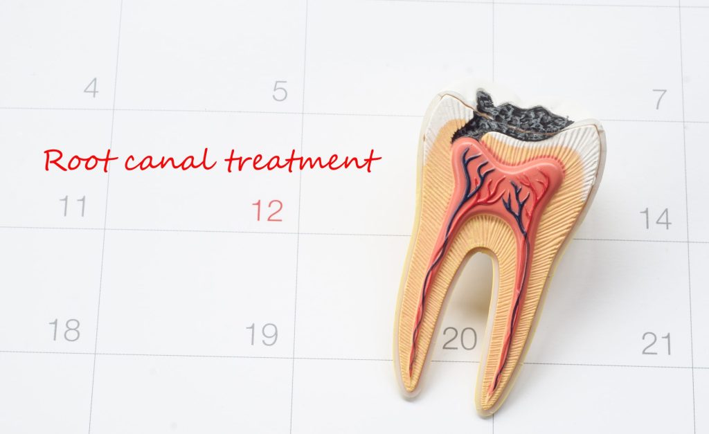 How to Prepare for Your Root Canal