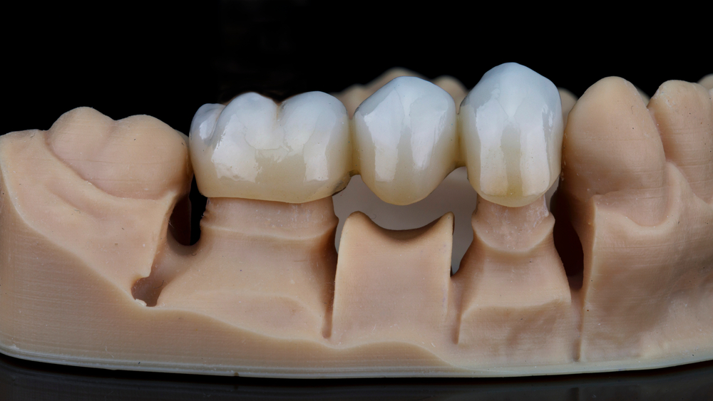 dental bridge form