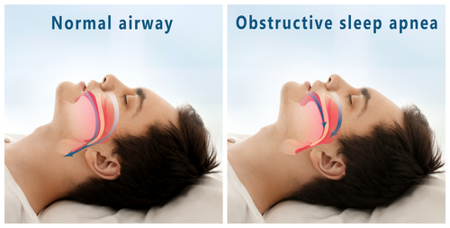 sleep apnea diagram